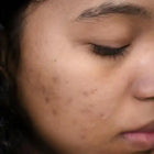 Human face with acne scars.
