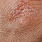Dry, cracked, and irritated skin.