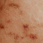 Skin with purplish bruises.