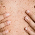 Skin with numerous brown spots.