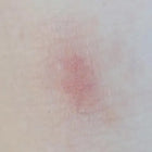 Pinkish-red skin lesion with white scales and surrounding erythema