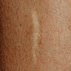 Raised, pale skin scar.